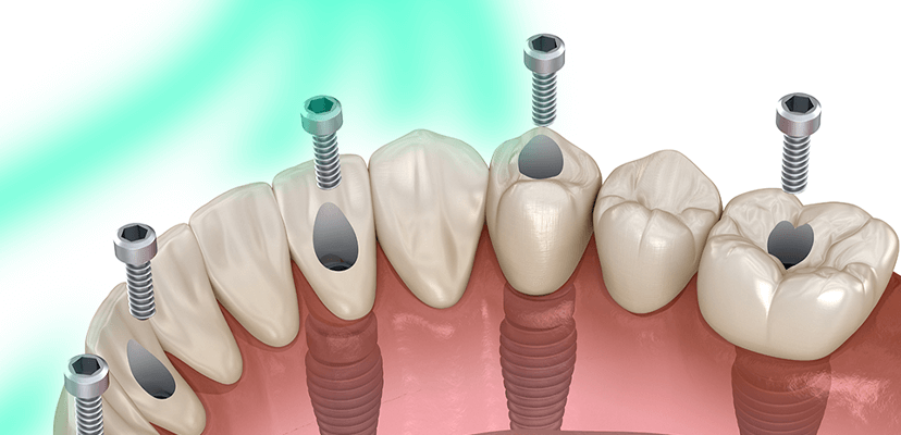 All-on-4 und All-on-6 Zahnimplantate
